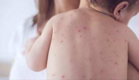 Measles case confirmed as experts fear UK faces worst outbreak in 12 years mirror.co.uk/news/health/br…