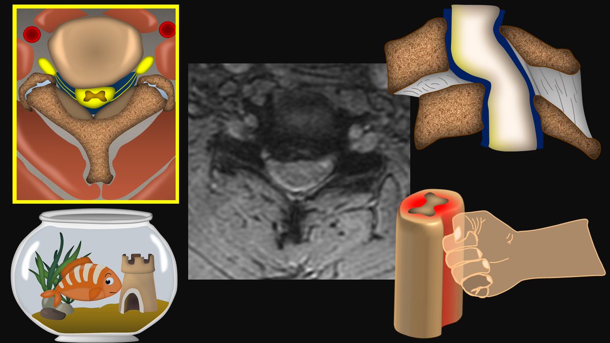 1/Have disagreements between radiologists on the degree of cervical canal stenosis become a pain in the neck?!

Worried about sticking your neck out and calling severe cervical stenosis?

Here’s a thread on cervical stenosis grading that’s easy, reproducible & evidence based!