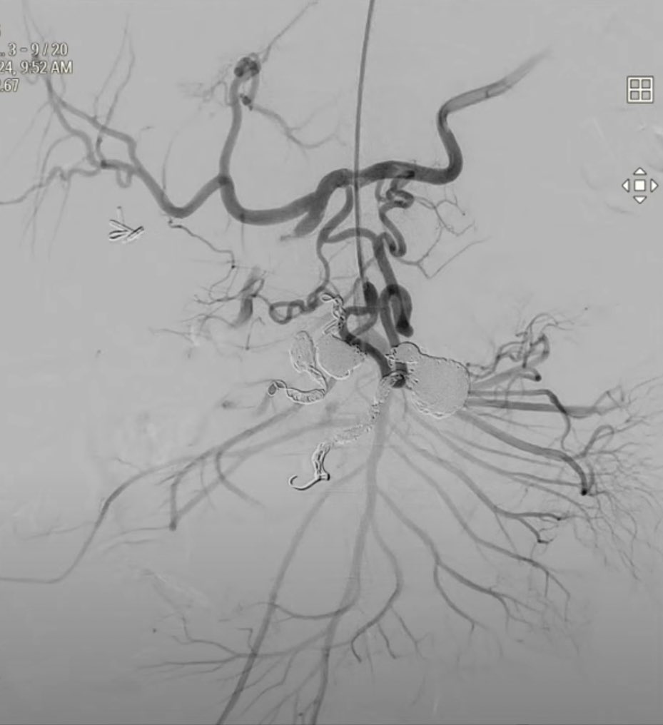 #TREATLIVE SMA Aneursym Embolization final result. Thank you for tuning in and see you next month for the next #TREATLIVE case! <a href="/RSP516/">Rahul Patel</a> <a href="/vivianbishay/">vivian bishay</a> <a href="/Timothy_Carlon/">Tim Carlon, MD, MBA</a> <a href="/_backtable/">BackTable Vascular and Interventional</a> <a href="/SIRspecialists/">Society of Interventional Radiology</a>