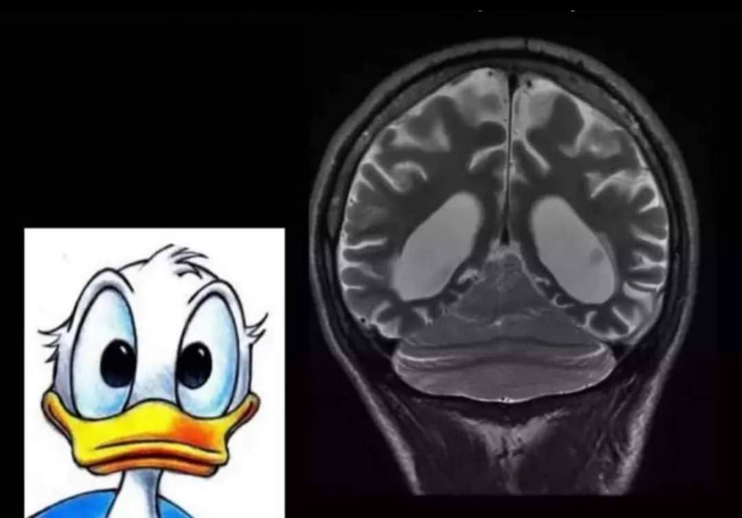 Neuromed_'s tweet photo. Donald Duck sign. What is your diagnosis?
#MedX #MedEd https://t.co/yVE6QtsFia