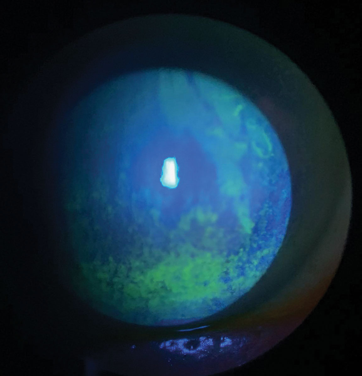 Maximum Blink Interval Helps Detect Dry Eye Cases with Mismatch of Signs vs. Symptoms The findings were diagnostic in patients when TBUT and Schirmer’s scores weren’t. reviewofoptometry.com/article/maximu… #dryeye #cornea #ded #eyecare #optometry