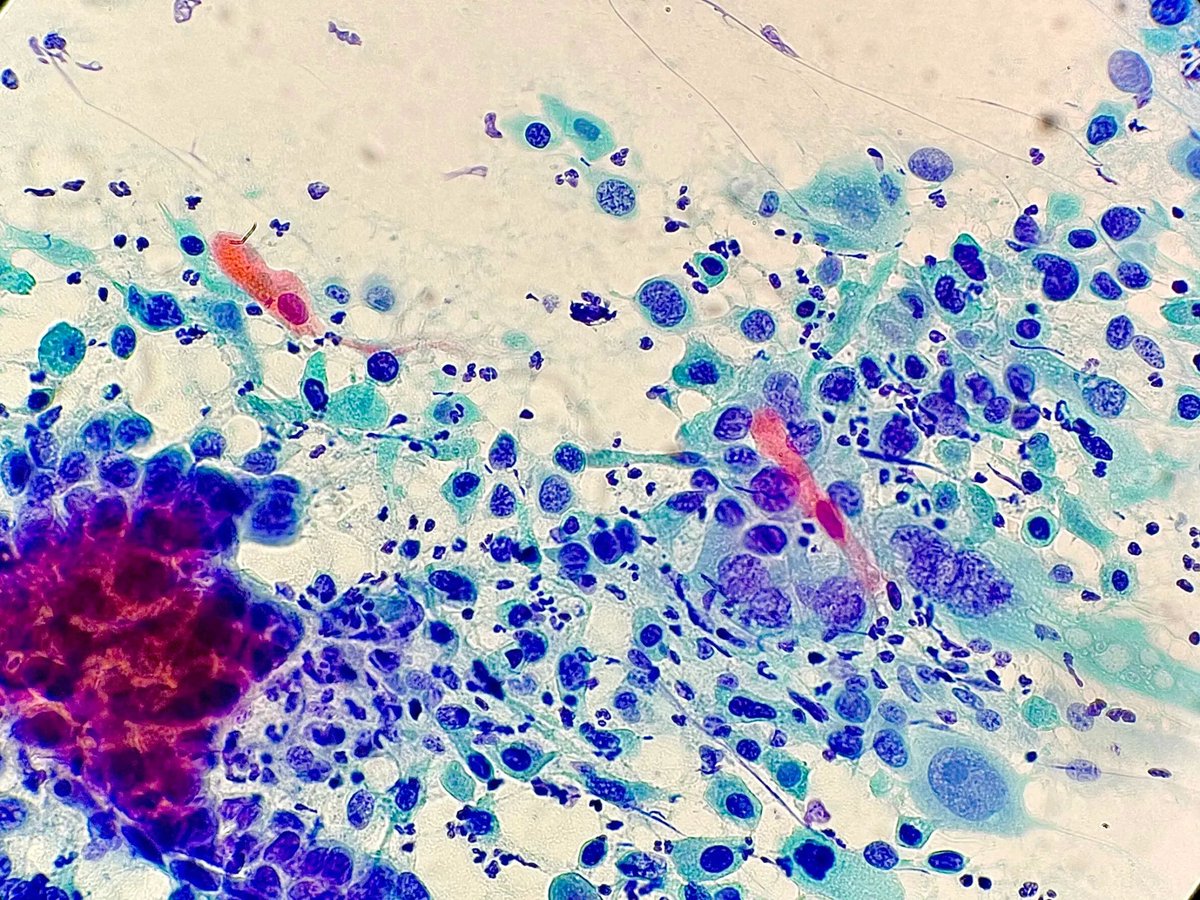 Fine needle aspiration of a neck lymph node. What is the diagnosis? Answer: buff.ly/3GvZfbO
#PathArt #PathTwitter #Cytopath #Pathology