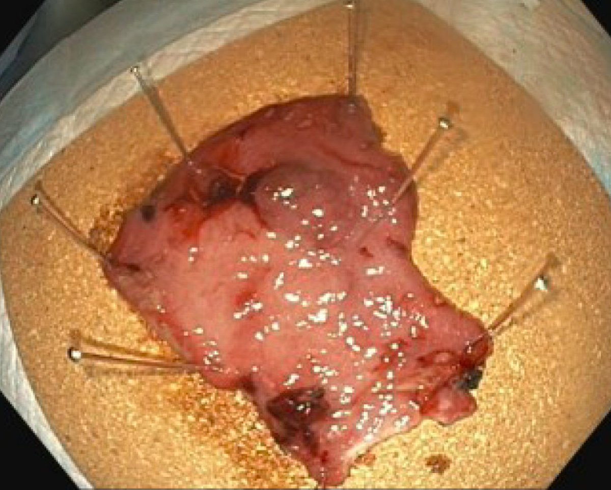 Gastric ESD 🔪: Pocket-Creation Method 💡Better recognition of SM from MP with advanced fibrotic lesions 💡Maintain a longer submucosal injection as less leakage of solution when maintained in pocket ⬇️Localized poorly diff carcinoma in nonsurgical candidate #GITwitter #MedEd