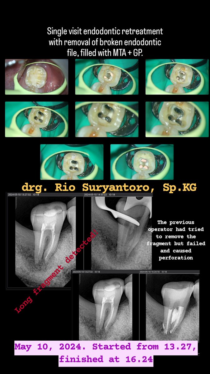 Single visit endodontic retreatment with removal of broken endodontic file, filled with MTA + GP.
May 10, 2024. Started from 13.27, finished at 16.24
The previous operator had tried to remove the fragment but failed and caused perforation.

#endodontist #doktergigi