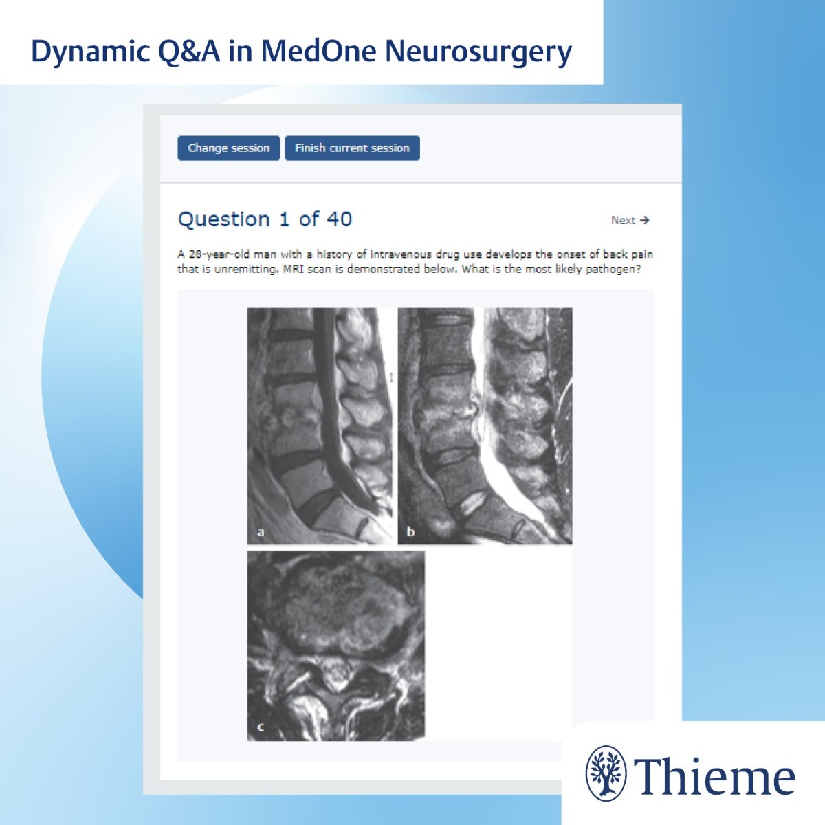 Quiz Time with MedOne #Neurosurgery! 🤔 What is the most likely pathogen? A: Streptococcus milleri B: Stapholococcus aureus C: Stapholococcus epidermidis D: Enterococcus ___________ Try the new Q&A experience on MedOne ➡️brnw.ch/21wJEVw