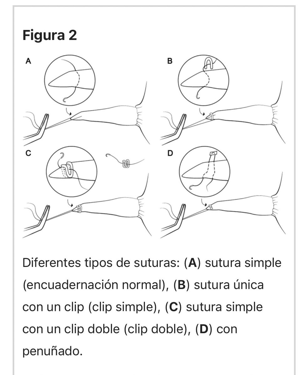 Cirugía de Atresia Esofágica 🧑🏻‍💻
Por técnica de tracción interna de Patkowski

Qué tipo de punto de Sutura es MEJOR?

El objetivo: determinar el mejor tipo de punto para el alargamiento esofágico en modelo animal.
🪡 PreMicron 2/0 Poliéster aguja redonda de 26 mm

 #SoMe4PedSurg