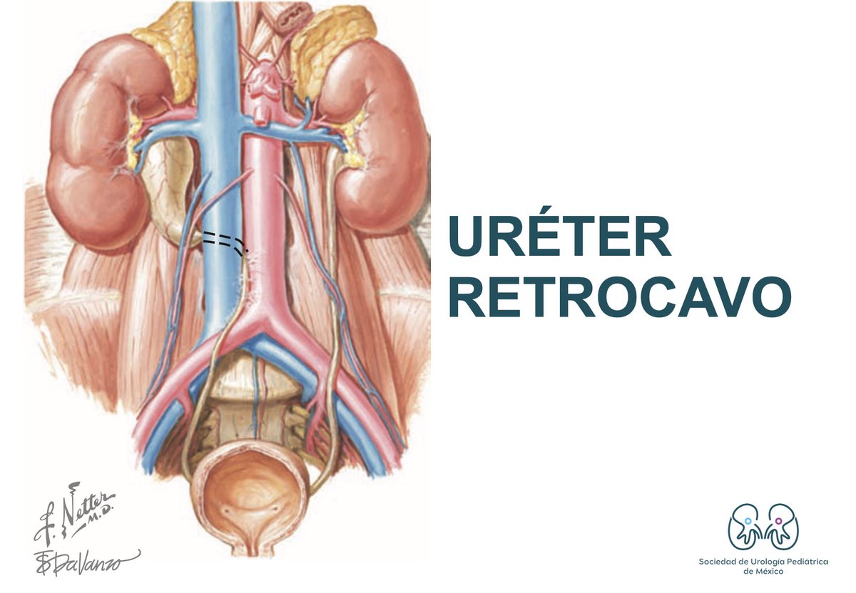 ¿Qué es el URÉTER RETROCAVO?🧐📚

📌Malformación congénita que se caracteriza por un trayecto espiral🌀 del uréter alrededor de la vena cava inferior.

📌Etiología➡️ Desarrollo anómalo de la VCI por persistencia de la vena cardinal posterior derecha.

#SoMe4PedSurg #UroSoMe #MedX