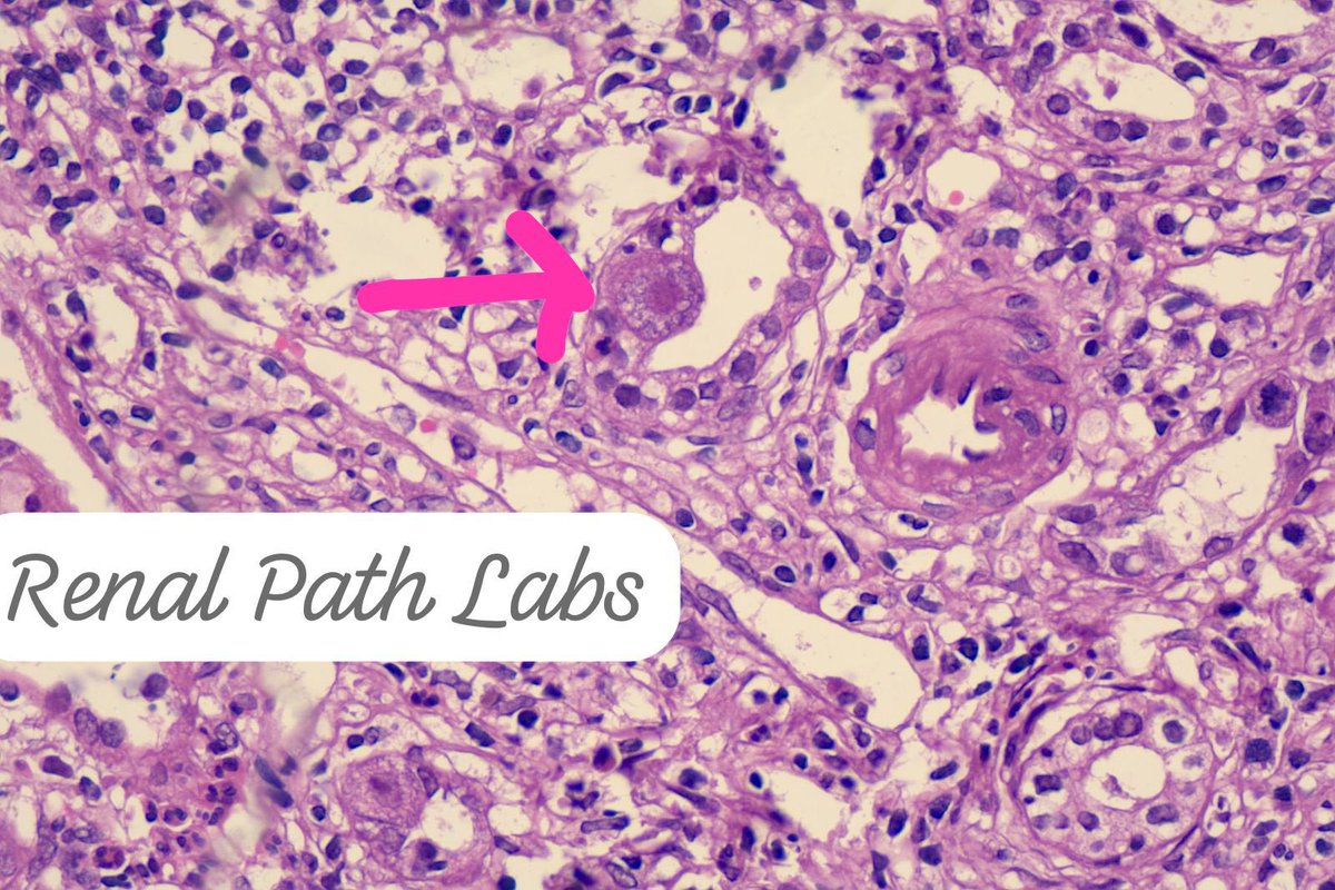 RenalPathLabs's tweet photo. Happiness is when you suspect something and IHC give a fierce looking nod!! Graft Biopsy.
You all will identify this,I am sure!
But this is a rare thing-documented cases r much lower in India
#RenalPathCases
#RenalPath #PoojaMaheshwari
#TransplantPathology #AskRenal #AskRenalPath https://t.co/U9H9HtZmG5