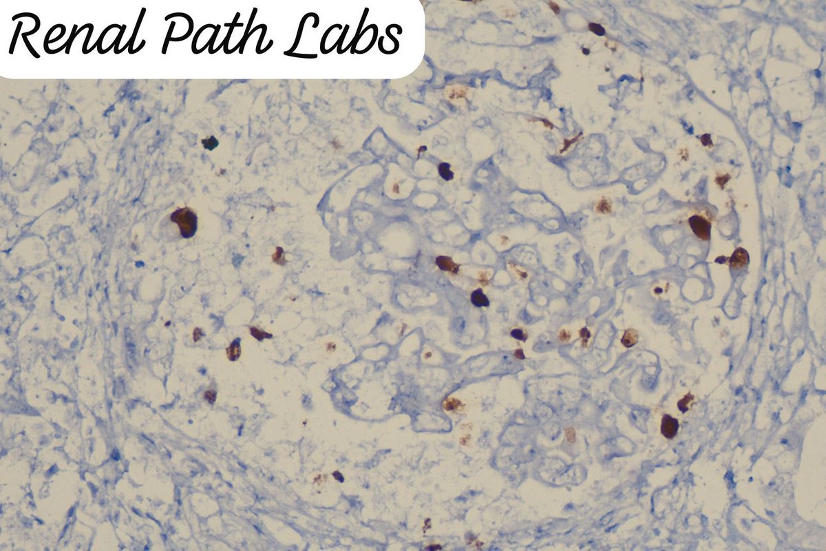 RenalPathLabs's tweet photo. Happiness is when you suspect something and IHC give a fierce looking nod!! Graft Biopsy.
You all will identify this,I am sure!
But this is a rare thing-documented cases r much lower in India
#RenalPathCases
#RenalPath #PoojaMaheshwari
#TransplantPathology #AskRenal #AskRenalPath https://t.co/U9H9HtZmG5
