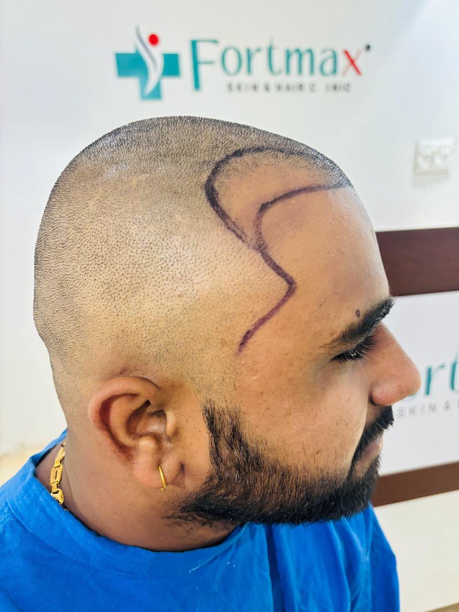 #FortMaxClinic #HairTransplant #HairRestoration #HairLossSolution #ConfidenceBoost #EMIOffer #HairRevival #NewYou #HairTransformation #SelfAssurance #HairCare #BeConfident #HairGoals #ModernSolutions #HairTransplantdoctor #HairTreatment #Hairfall #Hairgrowth #Hairsolution #Hair