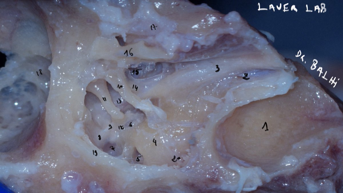 How many structures are you able to recognize?  An image that's worth sharing, I suppose. It shows a nice view of the human middle ear after the dissection of the temporal bone (with the tympanic ring and tympanic membrane removed).