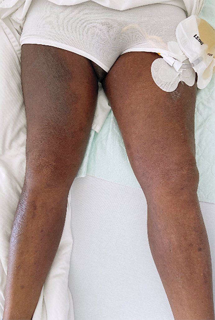 A 72-year-old man who had emigrated from Zimbabwe 20 years previously presented with a 17-year history of swelling of the penis, scrotum, and left leg. Read the full clinical case from @UniBasel_en: nej.md/3JK9VWF