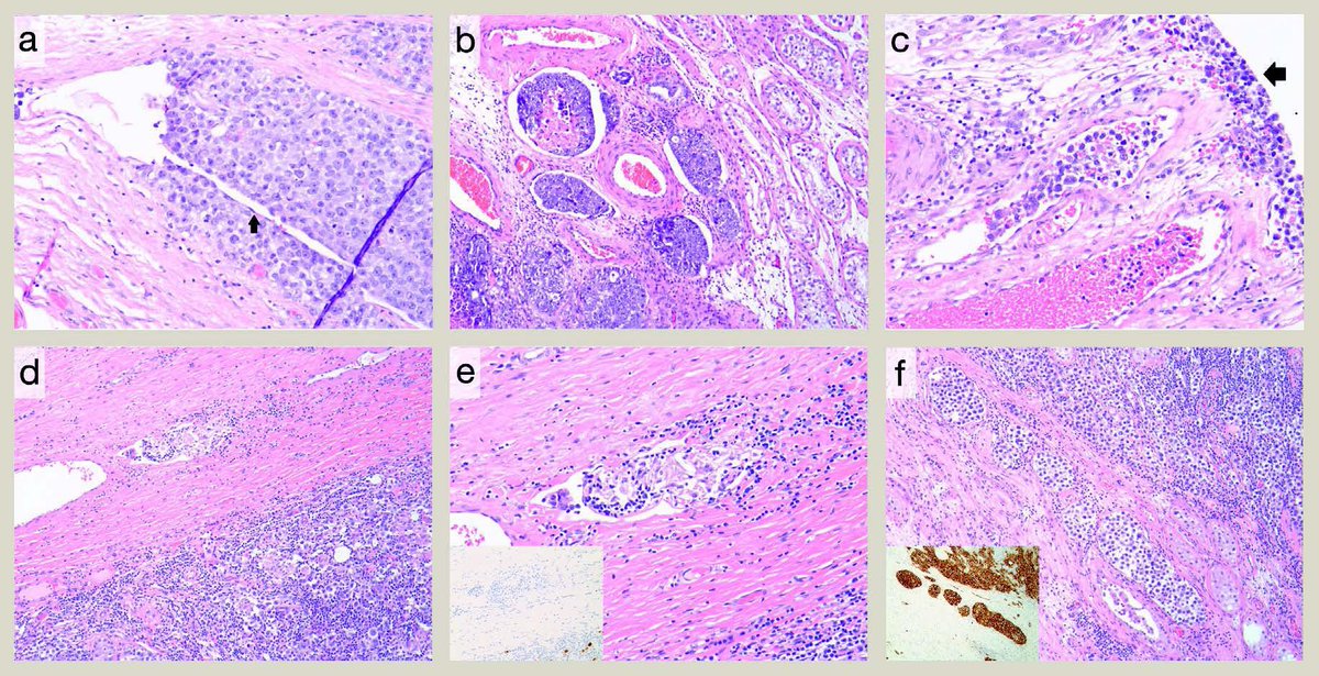 Liang Cheng, MD (@liangchengmd) on Twitter photo Happy Friday! Glad to share this article just published in May issue of Diagnostic Histopathology. We reviewed common pitfalls in diagnosis and staging of #testicularcancer.
sciencedirect.com/science/articl…
<a href="/BrownPathRes/">Brown University Pathology Residents & Fellows</a> @BrowPathology Happy Friday! Glad to share this article just published in May issue of Diagnostic Histopathology. We reviewed common pitfalls in diagnosis and staging of #testicularcancer.
sciencedirect.com/science/articl…
<a href="/BrownPathRes/">Brown University Pathology Residents & Fellows</a> @BrowPathology