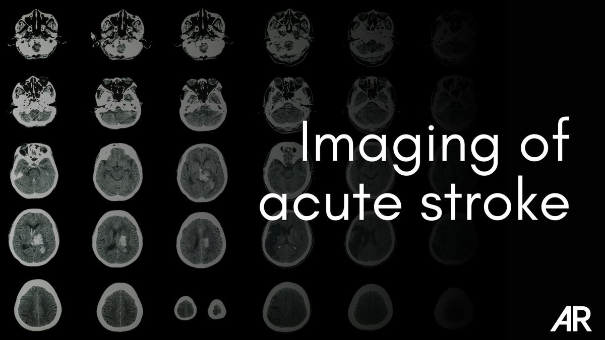 The current role of imaging in patients with acute onset of stroke-like symptoms includes ruling out nonvascular causes of stroke-like symptoms, excluding intracranial hemorrhage, and more... Read on ➡️ bit.ly/3ygtOCn #StrokeAwarenessMonth #NeuroImaging