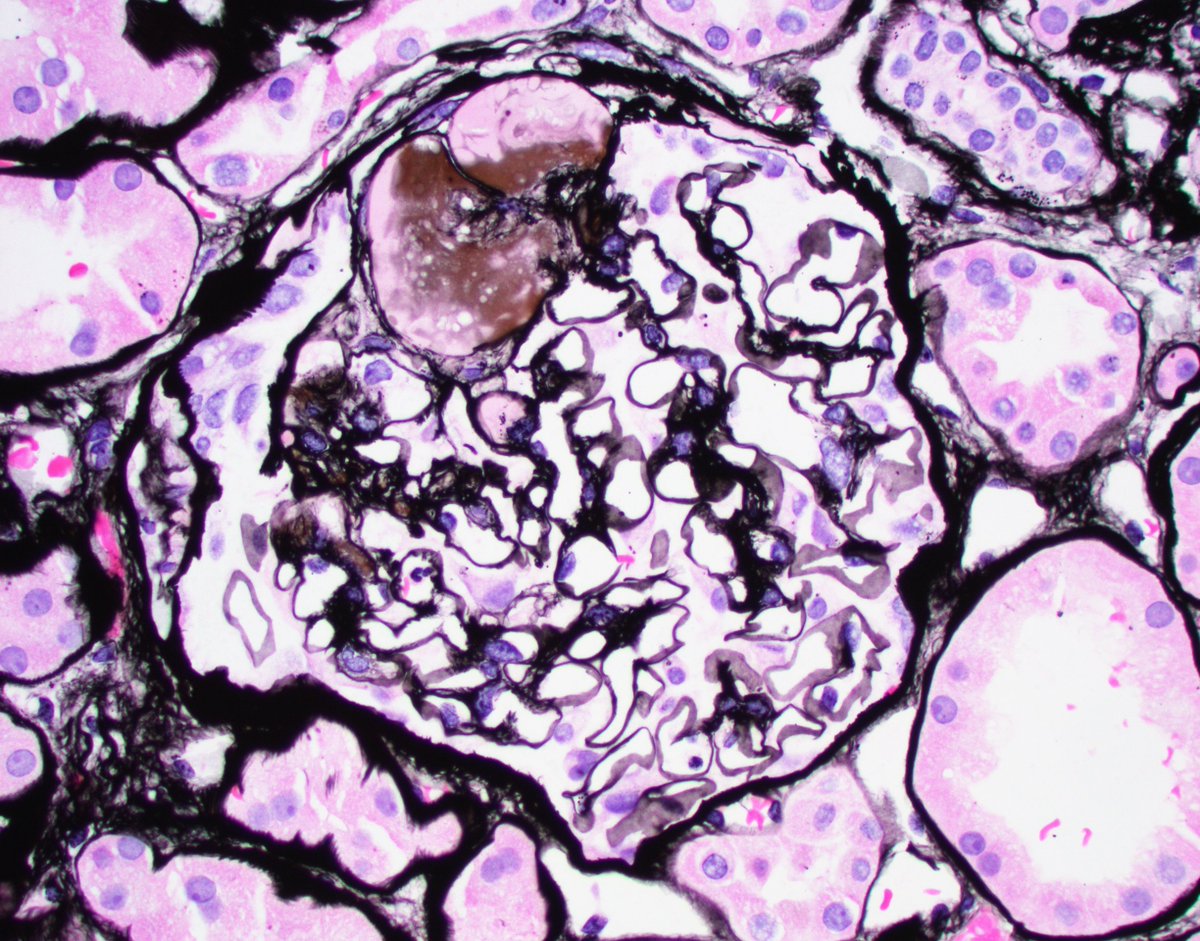 Interesting #onocnephrology #renalpath bx. Pt on long term gleevec for GIST with increasing proteinuria. Bx revealed chronic active microangiopathy and associated secondary FSGS. #nephrology #pathtwitter