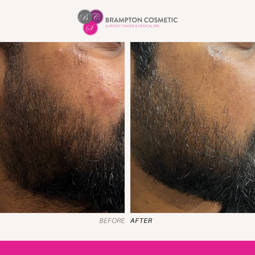 Achieve smoother, clearer skin with microneedling! 🌟 Check out these results and visit Brampton Cosmetic to explore our newest mirconeedling treatment addition, purasomes - perfect for hair loss and flawless skin! 😍
#BramptonCosmetic #MedSpa #CosmeticSurgery