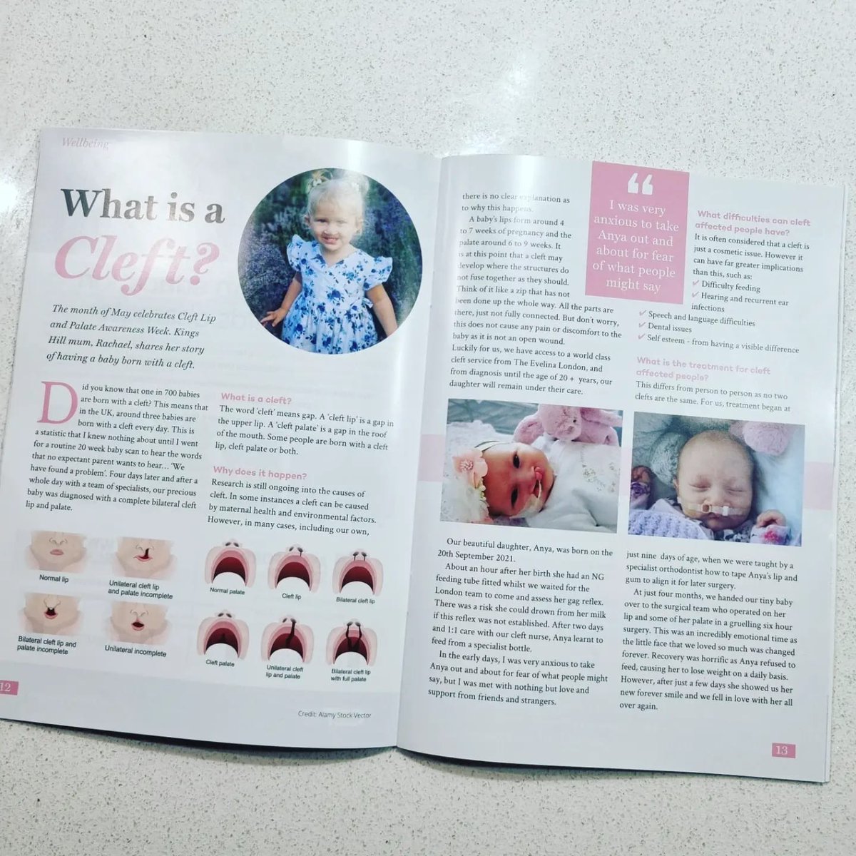For #cleftawarenessweek, our Cleft Community Advisory Council member, Rachael, has been raising awareness about what a cleft is and her journey as a cleft-affected parent in a local magazine!