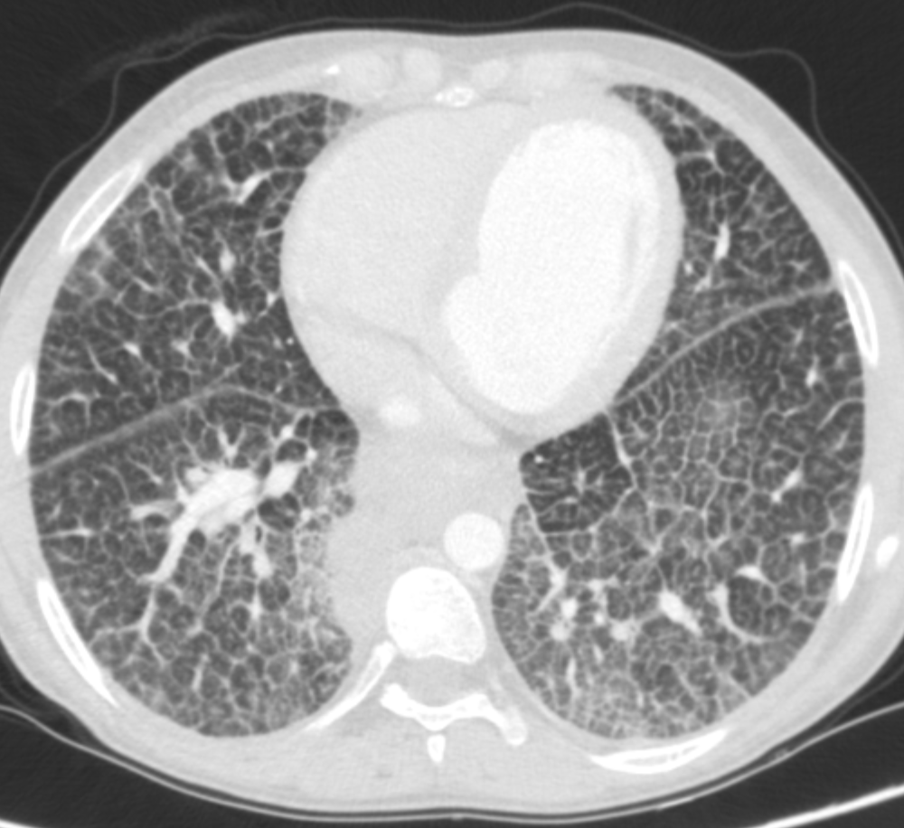 marcosmestas's tweet photo. Classic CT of Niemann-Pick disease with diffuse crazy paving pattern

Associated with severe esplenomegaly and paraesophageal varices

Case courtesy @marianlorea

@TLHM_MD @Marcelo97843311 @meldincarvalho 
#Radiology https://t.co/2ZQry9Kmy1