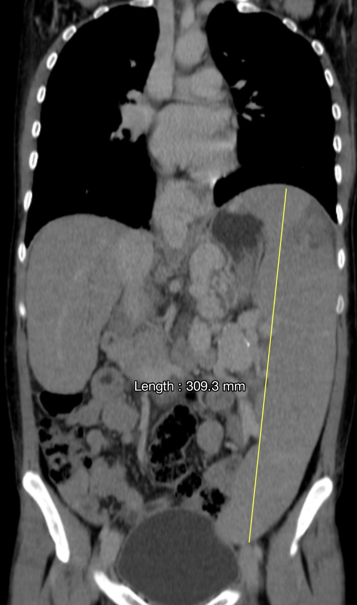 Classic CT of Niemann-Pick disease with diffuse crazy paving pattern Associated with severe esplenomegaly and paraesophageal varices Case courtesy @marianlorea @TLHM_MD @Marcelo97843311 @meldincarvalho #Radiology
