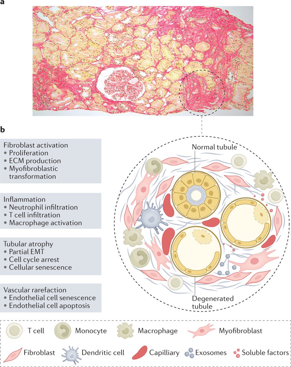NatRevNeph's tweet photo. Renal fibrosis initiates at distinctive focal sites of the kidney parenchyma https://t.co/j7nntywEIl https://t.co/RQVpLz55hw