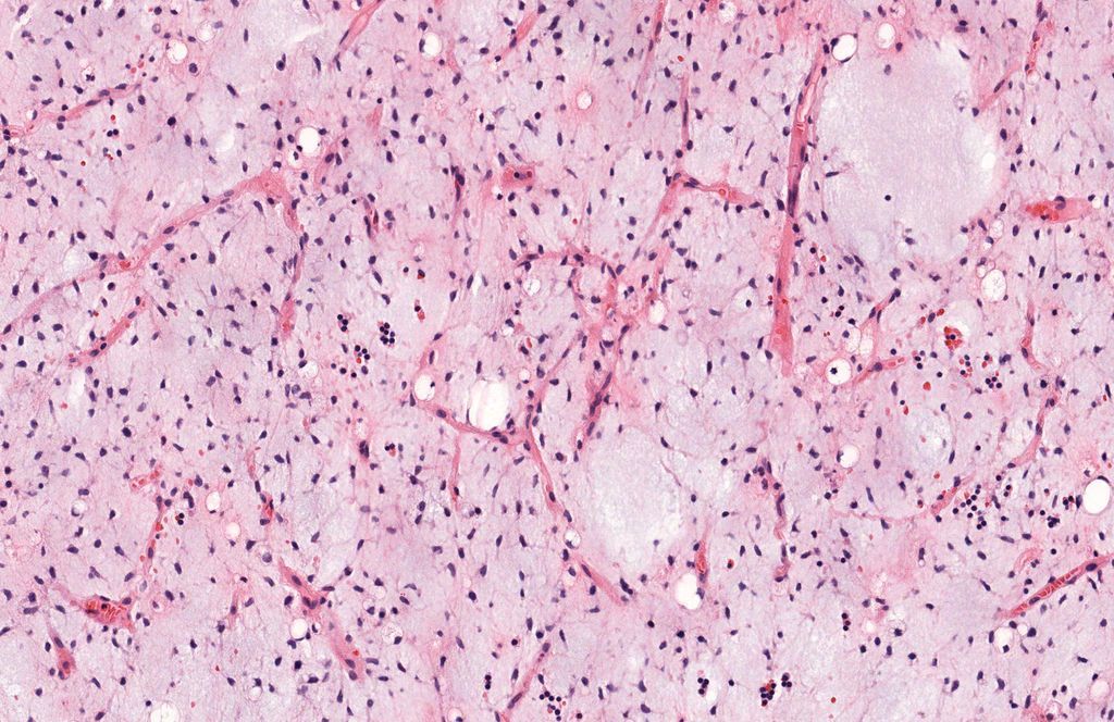 Young adult with deep thigh mass. Your diagnosis from this pic? Or is it #TooCloseToDiagnose? WSI digital slide: kikoxp.com/posts/8140. Answer & video: kikoxp.com/posts/4684 #BSTpath #pathologists #pathology #pathTwitter