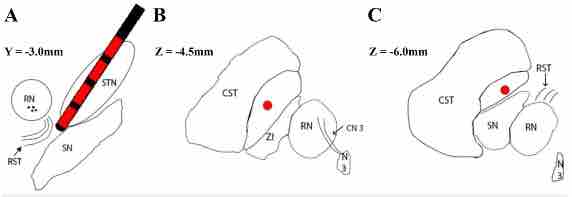 #JNSCaseLessons: An illustrative case of rubrospinal activation during asleep subthalamic nucleus deep brain stimulation as a false localizing sign thejns.org/caselessons/vi…