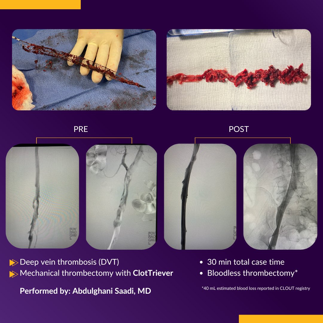 InariMedical's tweet photo. 59 y/o female admitted to the ER with pain and swelling in her left leg. Dr.Abdulghani Saadi used #ClotTriever to remove #clot and restore flow. Pain and swelling subsided post-procedure and patient left the hospital the following day. 

#DVT #deepveinthrombosis #thrombectomy

More on CT: https://t.co/JqTlqotncb