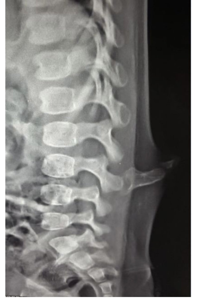 4 year old w/ progressive swelling at back. Yes, there is a digit growing from spine, please explain.