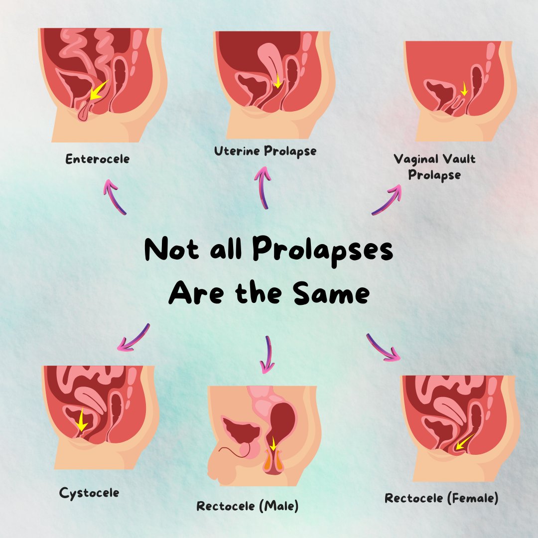 Each type is specific to the pelvic organ affected and can cause it's own set of symptoms. Your prolapse should be treated according to the type and your symptom(s) presentation. #prolapse #typesofprolapse #pelvicptnyc #pelvichealthpt #pelvicprolapse