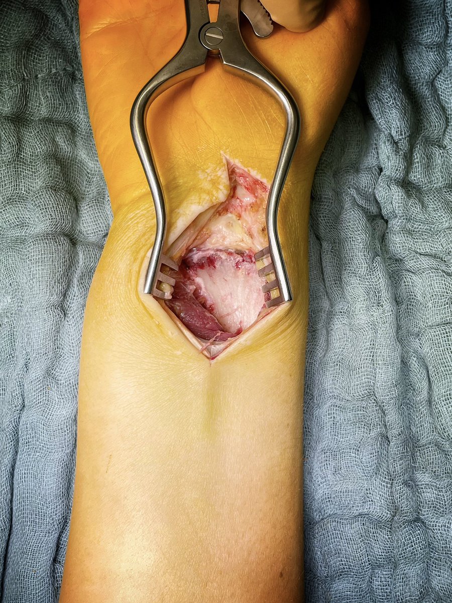 traumaticum's tweet photo. EFCR doesn’t *have* to mean the whole Orbay shebang of pronating the radius out of the forearm

EFCR can just mean following the FCR distally down to the tubercle of the trapezium and releasing radially

Puts you onto the volar rim over the whole width to the DRUJ

#orthotwitter https://t.co/uV3h2kSPUZ