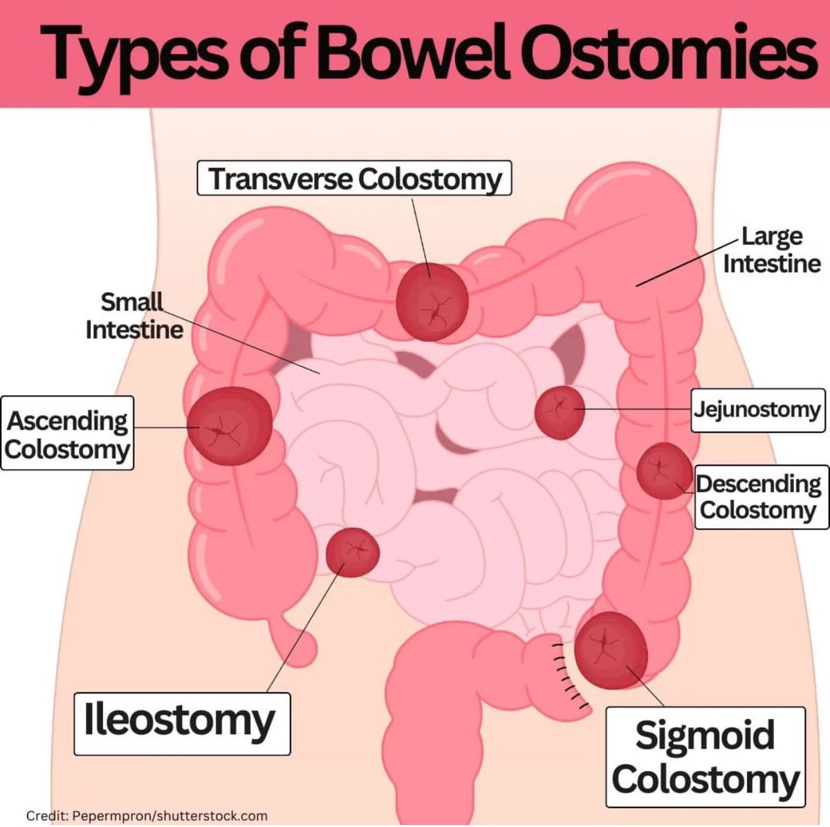 📌 Types of Ostomies ❓What kind of Ostomy do you have? #Ostomy #IBD H/T registerednursern_com