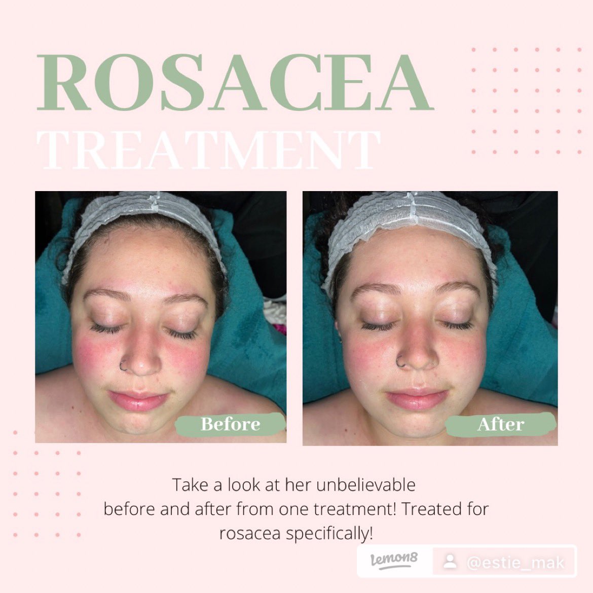 Makshroomm's tweet photo. Rosacea Facial for my best friend Kathleen! I used the ultra-cooling collection from @dermalogica 
This was just after one treatment! I can’t wait to see what we can do to her amazing skin. https://t.co/LsdPa2xG8i