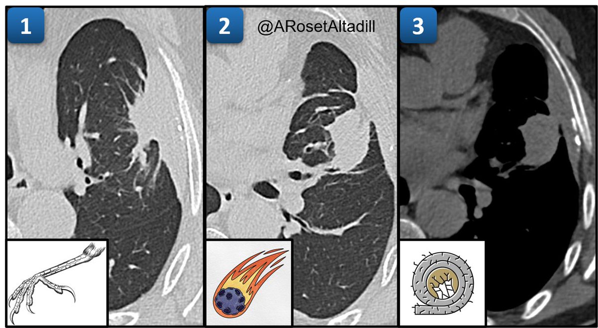 #17 Round Atelectasis

1⃣ Crow feet sign 🦅
2⃣ Comet tail sign ☄️
3⃣ Pleural plaque from asbestos exposure 🪨

Additional features: round morphology, contact with pleura & volume loss

❗️Not to be mistaken with malignancy 

#Radiology #chestrad #radres #FOAMrad #Rad2B #MedTwitter