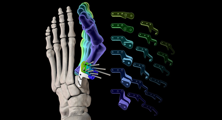 #ICYMI: This feature article examines the orthopedic extremities market with insights from @zimmerbiomet, @OrthofixMedical, #Stryker}, @DePuySynthes, @maxongroup, and @Cirtecmed: hubs.li/Q02wRkyJ0