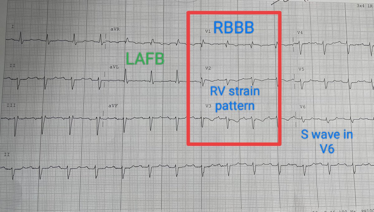 #ECG Features of RV enlargement; 1. Rbbb 2. RV strain pattern 3. S wave in V6 Bifascicular block - RBBB + LAFB Possible diagnosis; 1. Acute PE 2. Chronic Respiratory Disease like OSA/OHS/COPD