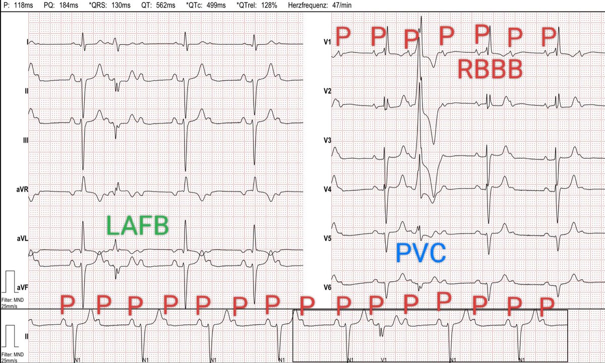 Lots of P waves seen here🫡