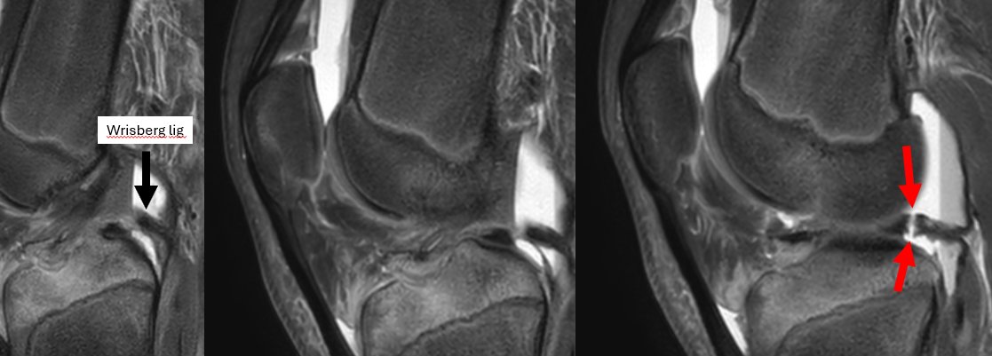 Wrisber Rip - longitudinal vertical tear at the junction of ligament of Wrisberg and posterior horn of the LM