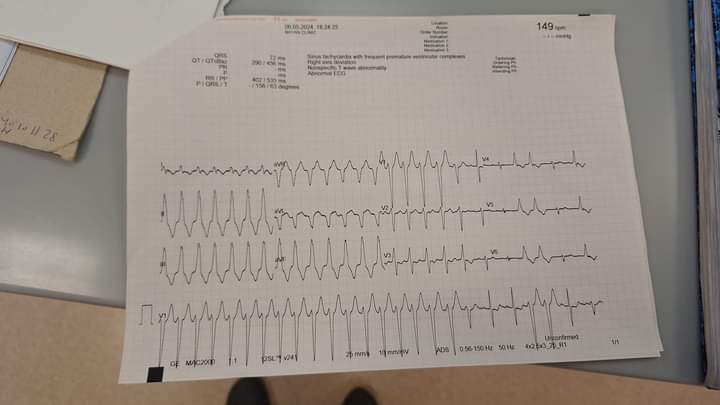 16 y o female with dextrocardia coming with palpitationsYour opinion ?
