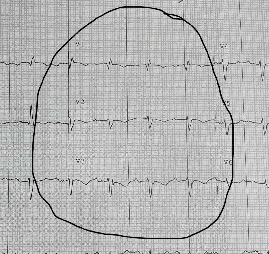 Shallow symmetrical T inversions with a broad base in V1–V3 in acute RV strain Last 4 cases with large Clot burden PE had similar appearance Any similar experiences @ecgrhythms @smithECGBlog @PendellM @adribaran @DidlakeDW @amalmattu @EM_RESUS @BrooksWalsh and others pls