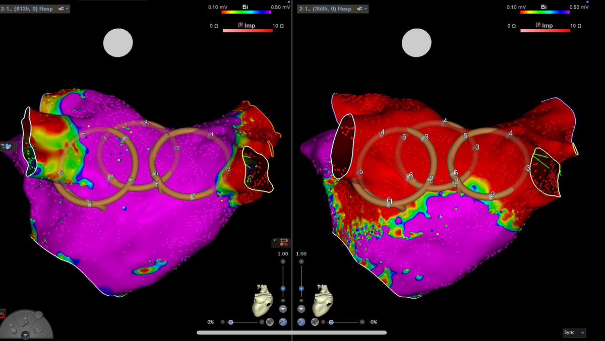 Eduardo Saad (@eduardosaad3) on Twitter photo Great persistent AF cases this week in Boston, using PFA Farapulse.
Fluoroless PVI + PW isolation. ICE in LA very helpful to visualize catheter contact and wire in PVs. <a href="/BidmcCvi/">BIDMC CVI</a> <a href="/Davilandre/">Andre d’Avila</a> <a href="/BIDMCVFellows/">BIDMC CV Fellowship</a> Great persistent AF cases this week in Boston, using PFA Farapulse.
Fluoroless PVI + PW isolation. ICE in LA very helpful to visualize catheter contact and wire in PVs. <a href="/BidmcCvi/">BIDMC CVI</a> <a href="/Davilandre/">Andre d’Avila</a> <a href="/BIDMCVFellows/">BIDMC CV Fellowship</a>