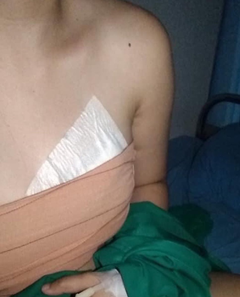 Hai, saya pengguna pil kb jangka panjang dan akhirnya tumbuh tumor payudara dan akhirnya dioprasi.