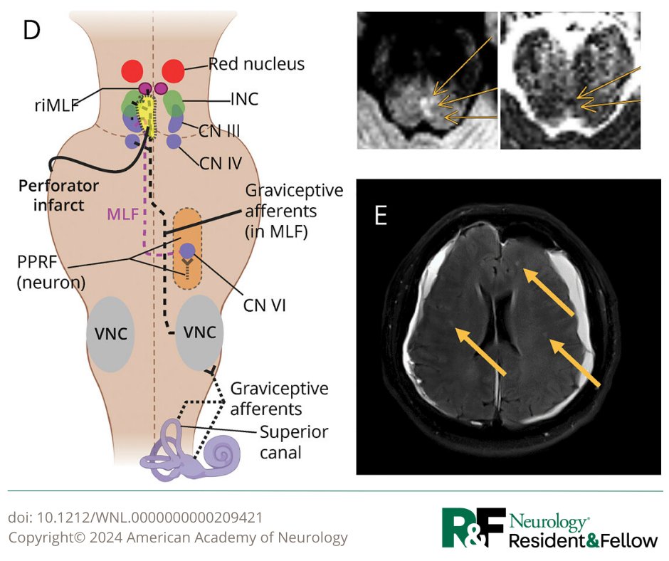 Pearls & Oy-sters: INO Plus From Downward Herniation—A Cautionary Tale Regarding Neuro-Ophthalmologic Signatures of Brainstem Compression bit.ly/3QBVWGy #NeurologyRF