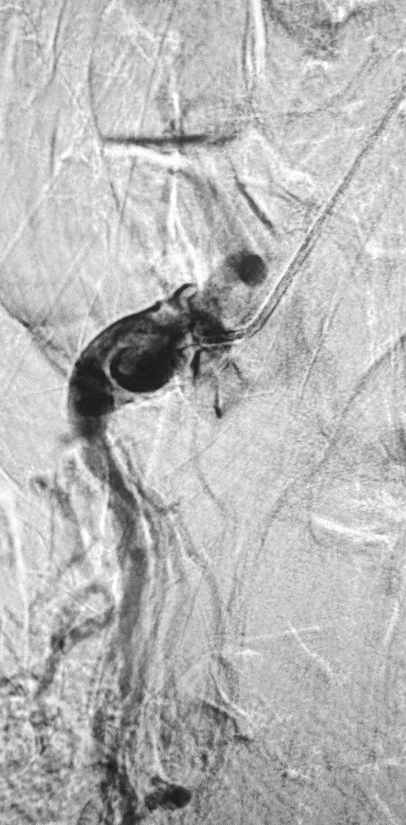 Let’s settle this ( hopefully)! What’s the right terminology to describe these angiographic findings? 2 patients, Iliac & SMA @DrPatGeraghty @Dr_Bowser @AmputationSuck @RKTvascular @limbsalvagedr @JimGMelton @canuc_57 @LessneVIR @marabi2004 @JayMathewsMD @kmadass @Watts_IR