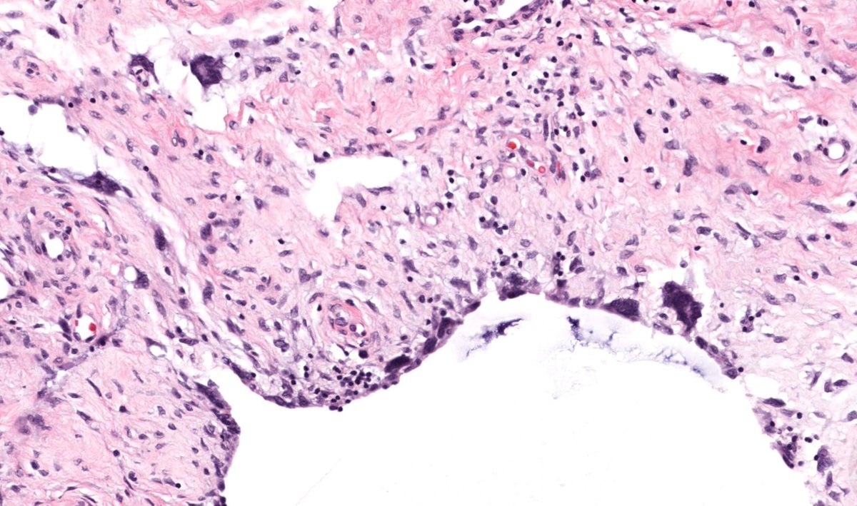20 F. Slowly growing 'cyst' on buttock for 5 yrs. Diagnosis?
WSI digital slides: kikoxp.com/posts/8158  
Immunostain: kikoxp.com/posts/11583
Answer & video: kikoxp.com/posts/11618
#pathology #pathologists #pathTwitter #dermpath #dermatology #dermtwitter #BSTpath