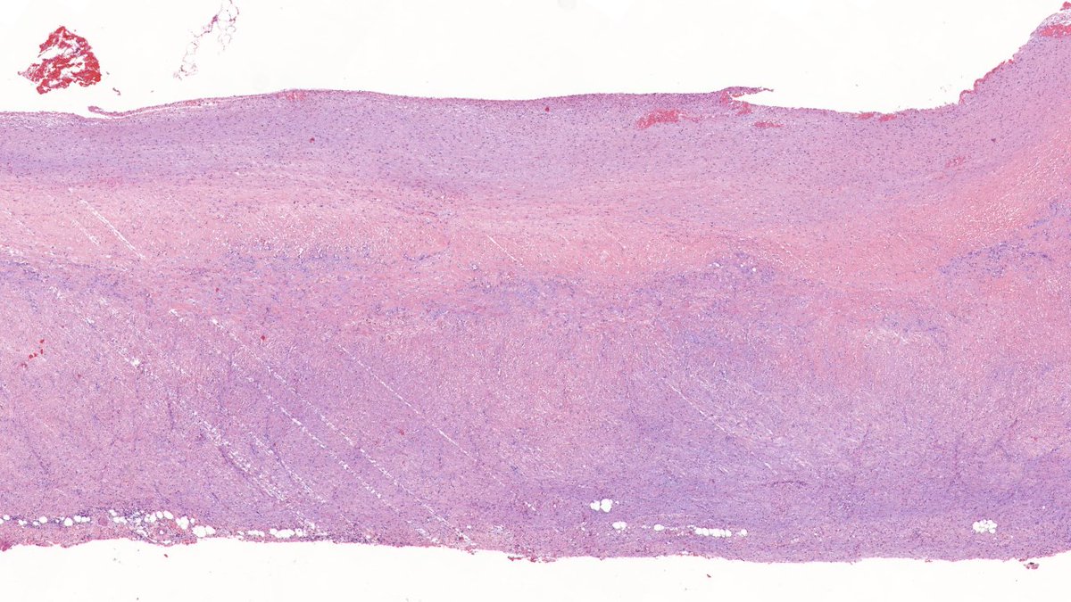 TristanRutland7's tweet photo. Pleural, adult

#Pathtwitter #Pathresidents #Pulmpath #MedTwitter https://t.co/FcPWoz1uXY