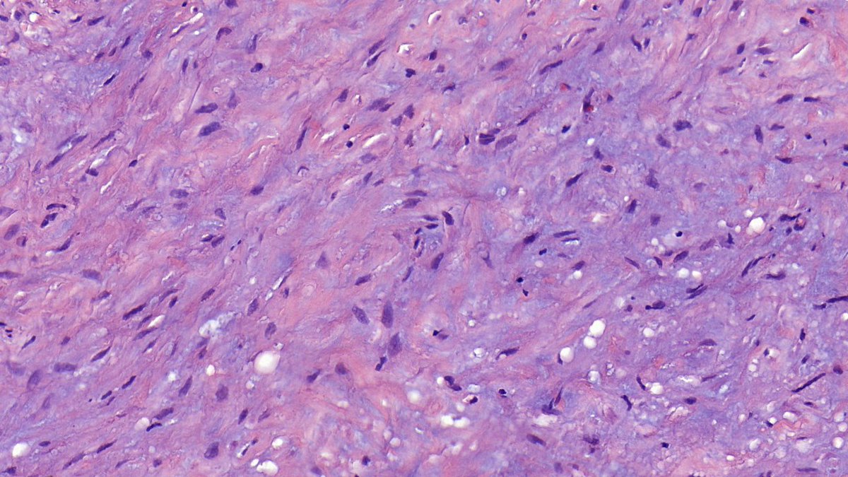 Pleural, adult

#Pathtwitter #Pathresidents #Pulmpath #MedTwitter