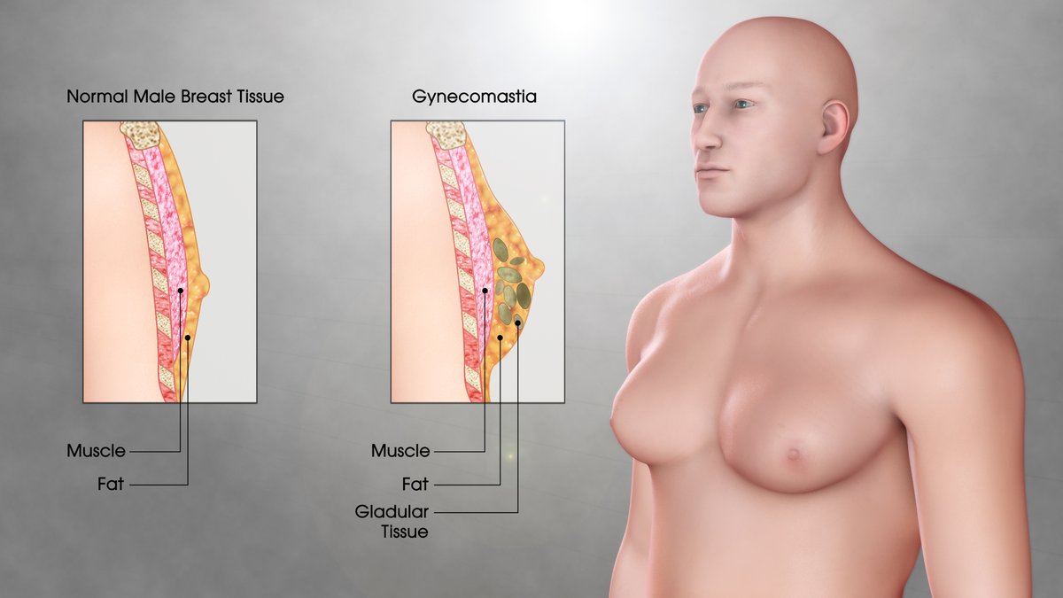 💊Spironolactone is a mineralocorticoid receptor antagonist which may produce impotence & gynecomastia.
📍MECHANISM: Spironolactone binds to androgen receptors producing an anti-androgen effect, while leaving estrogen unopposed.

#MedEd #MedX #diuretics #ClinicalPearl #MedTwitter
