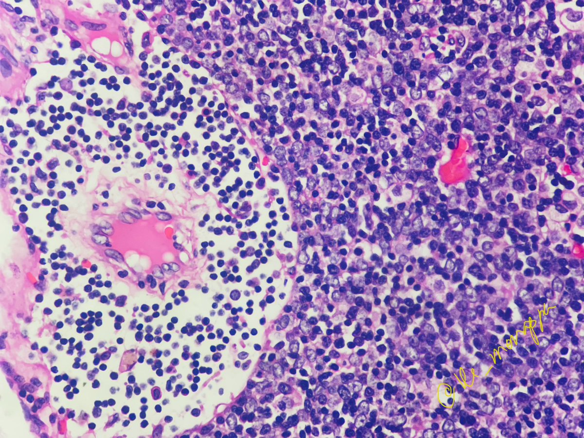 #pathx #pathresidents #pathquiz #1picdiagnosis
Can u guess the diagnosis based on this one pic ? Spotter ☺️