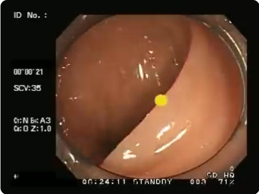 prostate727's tweet photo. ヒューストン弁

直腸のヒューストン弁がよくわかる動画

青〇が第１Ｈ弁、赤〇が第２Ｈ弁、黄〇が第３Ｈ弁

絵を見るのとは違い動画を見ると人それぞれのアナルですね
#アナル #ヒューストン弁

カール先生の大腸内視鏡挿入術
https://t.co/EnOs9hOgWB https://t.co/kDuH1kPeDA