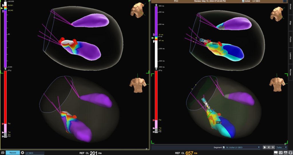 Edward Cheng, MD, PhD (@drepcheng) on Twitter photo The posteromedial pap muscle well defined by #PDX Initial mapping led to the PM tip. RFA shifted exit to the mid aspect then suppressed. Great mapping <a href="/georgecrowell/">George Crowell</a> #Epeeps The posteromedial pap muscle well defined by #PDX Initial mapping led to the PM tip. RFA shifted exit to the mid aspect then suppressed. Great mapping <a href="/georgecrowell/">George Crowell</a> #Epeeps